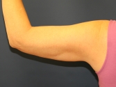 Feel Beautiful - Thermi to Arms - Before Photo